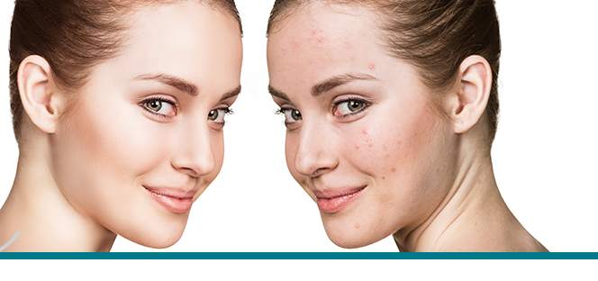 acne scars treatment